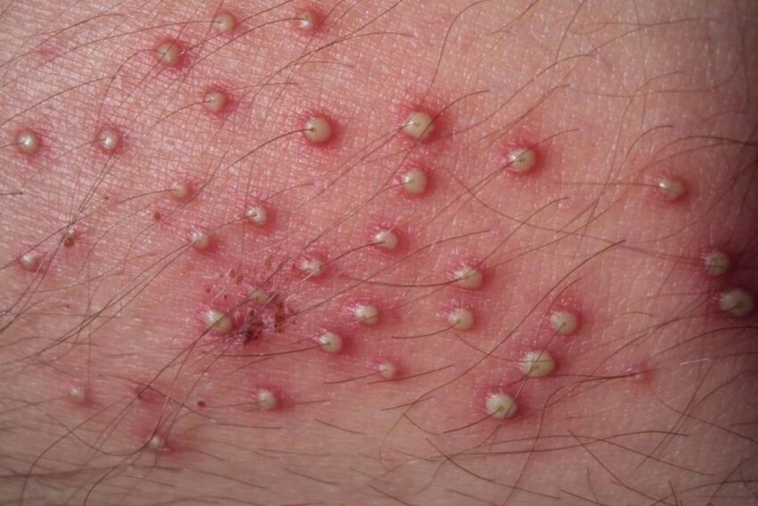 Bệnh Lây Truyền Qua Đường Tình Dục