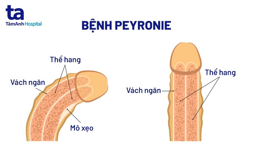 Nguyên Nhân Dương Vật Bị Cong