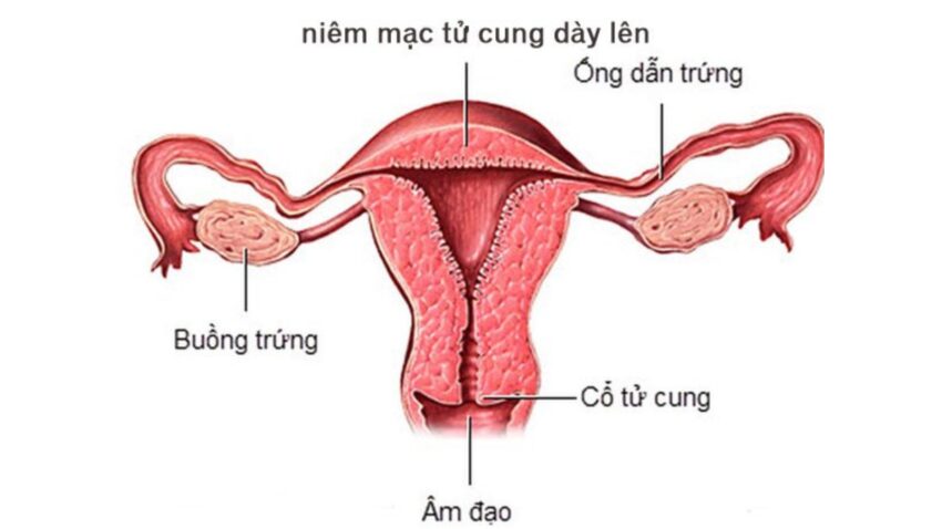 Nội mạc tử cung dày