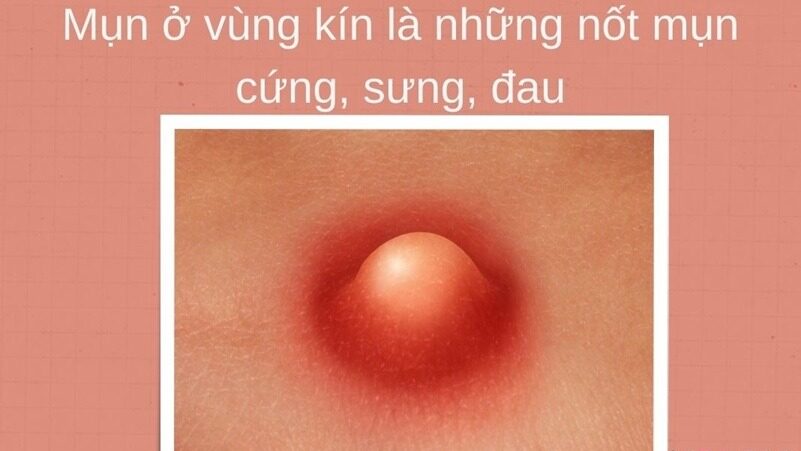 Phân Biệt Mụn Âm Đạo Lành Tính Và Các Bệnh Lý