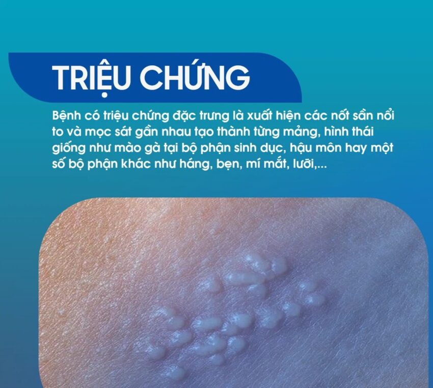 Sùi mào gà mọc ở đâu