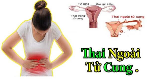 Thai Ngoài Tử Cung Phải Làm Sao