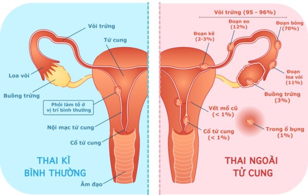 Mang Thai Ngoài Tử Cung