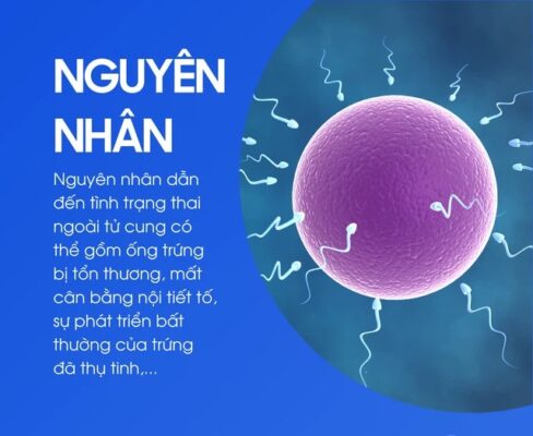 dấu hiệu thai làm tổ ngoài tử cung