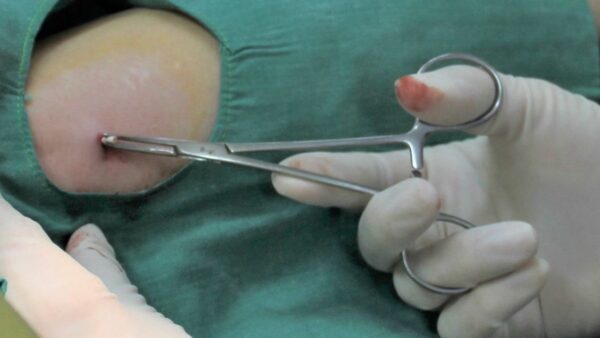 Tháo Que Tránh Thai Có Giảm Cân Không