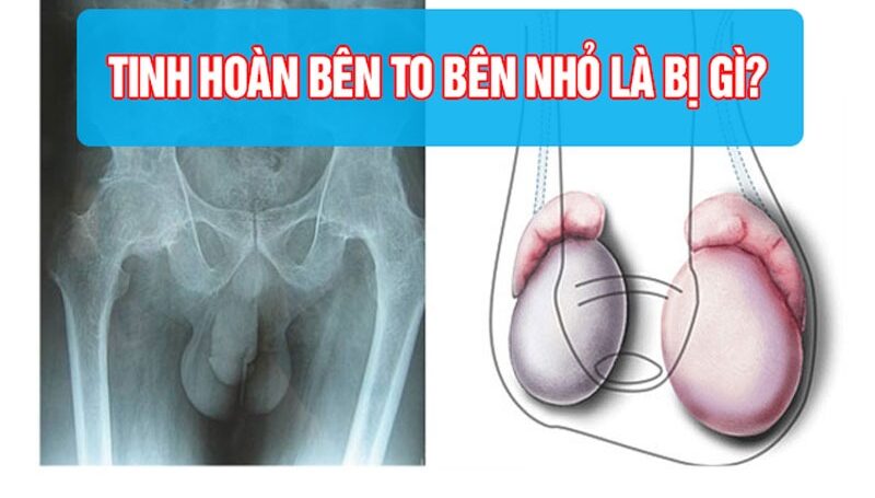 tinh hoàn bên to bên nhỏ