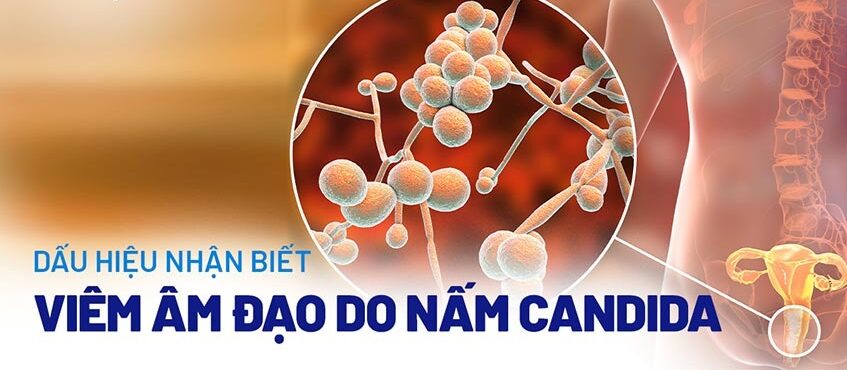 viêm âm đạo do nấm