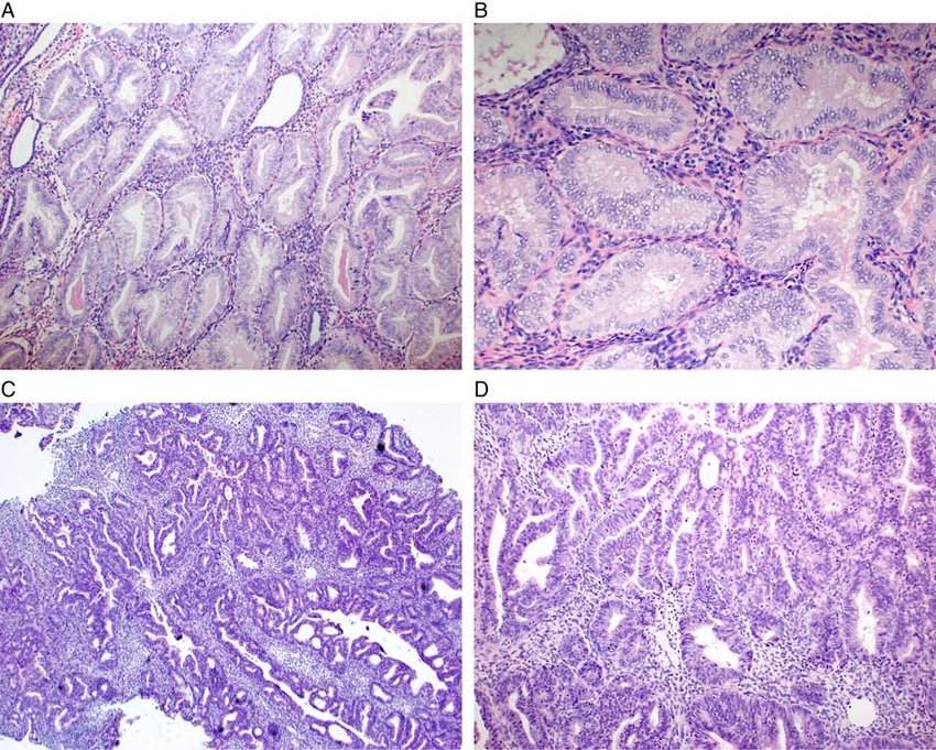 Atypical endometrial hyperplasia