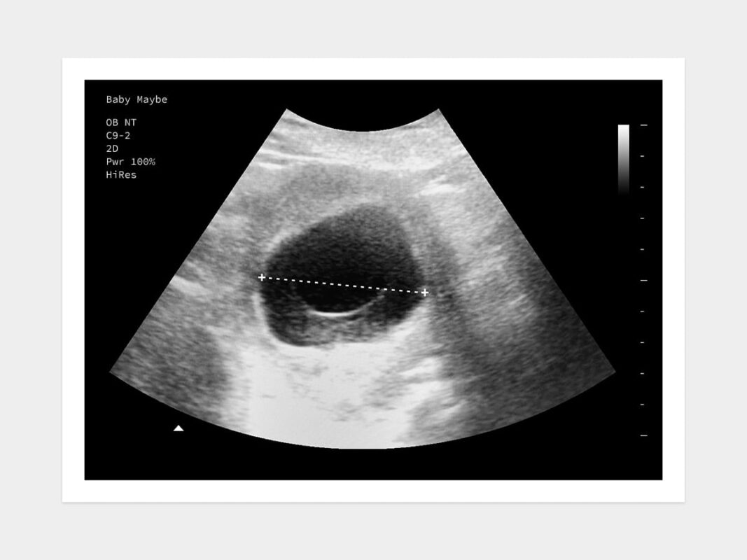 Blighted Ovum