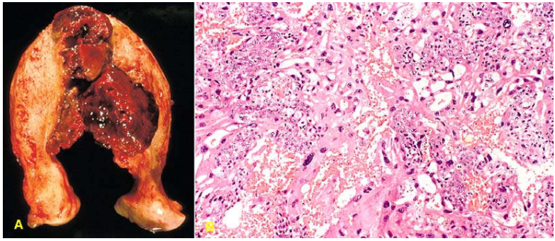 Ung thư nguyên bào nuôi (Choriocarcinoma)