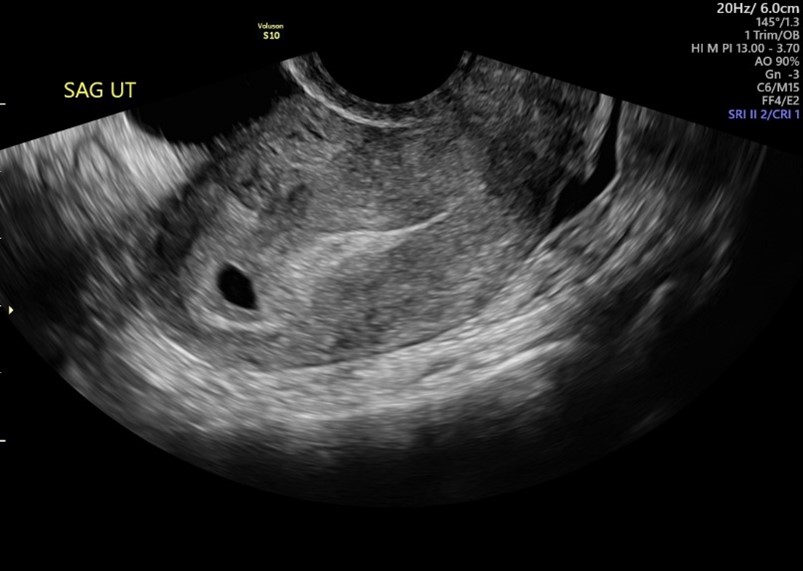 Gestational Sac