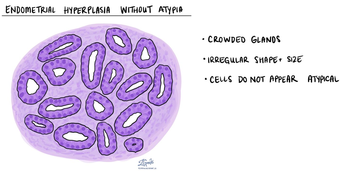 Hyperplasia without atypia