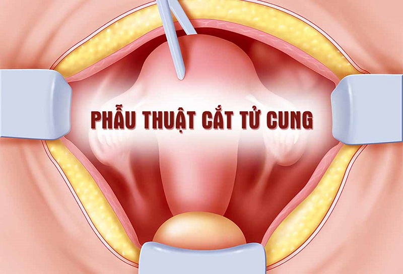 Cắt bỏ tử cung