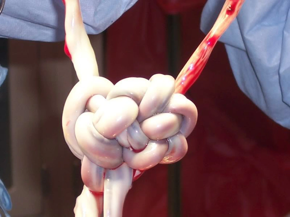 Dây rốn bị thắt nút