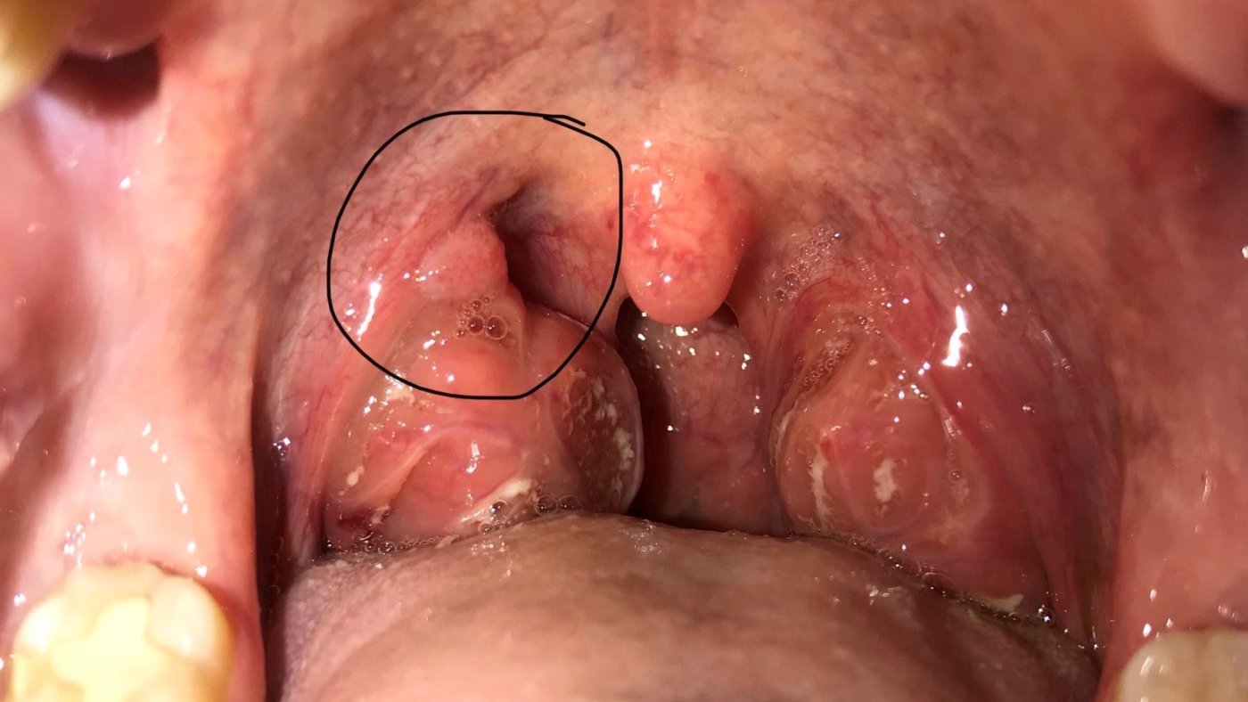 sùi mào gà ở họng