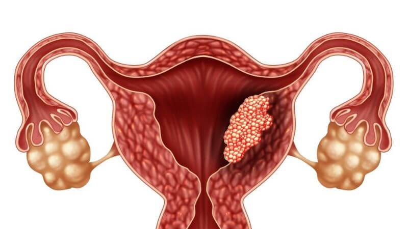 Tăng sinh nội mạc tử cung