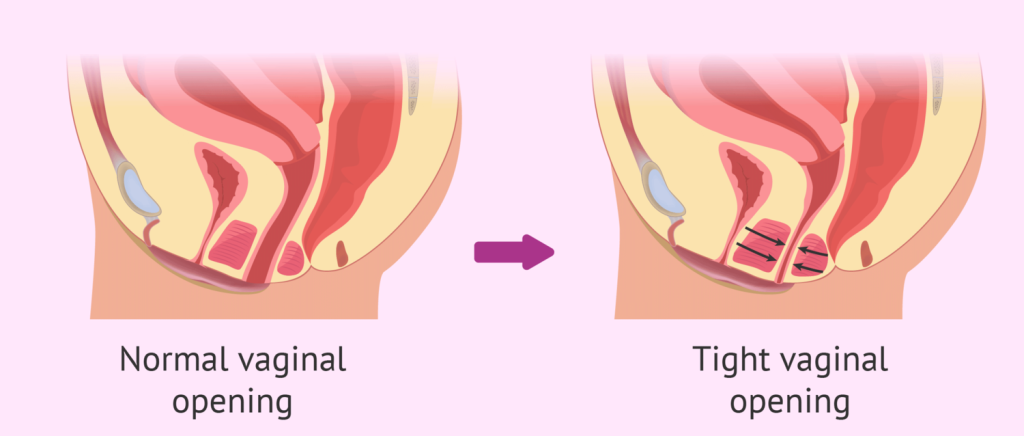 Vaginismus