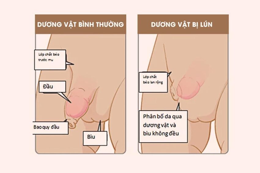 dương vật ngắn