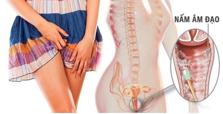 cách trị nóng rát vùng 