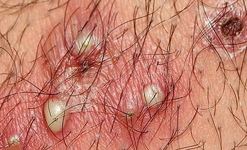 cách trị nóng rát vùng 