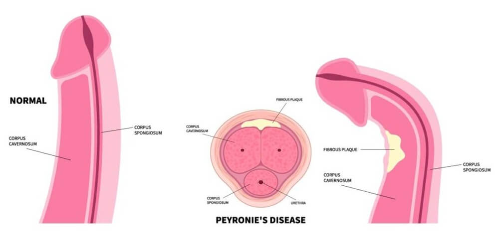 Cậu nhỏ bị cong sang trái: Thông tin, Nguyên nhân, Ảnh hưởng và Phương pháp điều trị 2 Congenital penile curvature