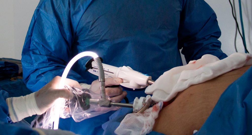 Laparoscopic appendectomy