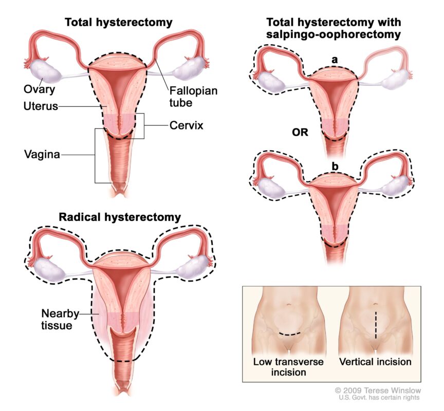 Total Hysterectomy