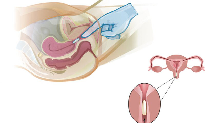 Đặt thuốc phụ khoa có quan hệ được không? Giải đáp, Rủi ro & Lưu ý y tế 1 Đặt thuốc phụ khoa có quan hệ được không