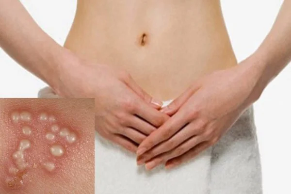 Mụn rộp sinh dục nữ