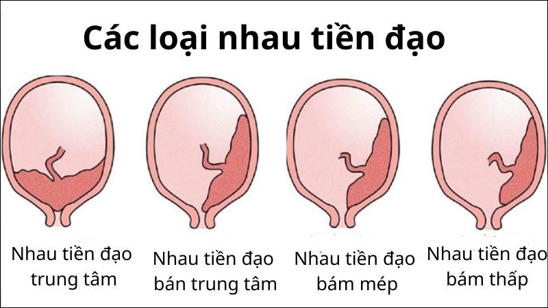 Tự sướng khi mang thai 3 tháng đầu: Thông tin Y khoa, Ảnh hưởng, Lợi ích, Rủi ro và Hướng dẫn an toàn 9 nhau tiền đạo