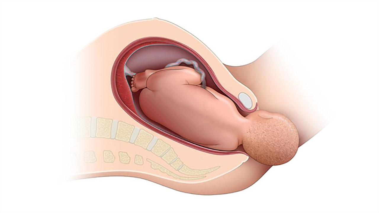 Cách nhận biết cô bé khít: Thông tin, Đặc điểm, Nguyên nhân và Yếu tố ảnh hưởng 10 Sinh thường