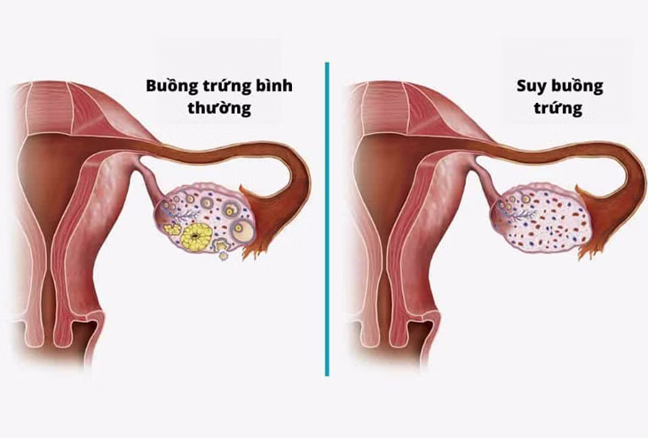 Que thử trứng rụng: Định nghĩa, Phân loại, Nguyên lý và Hướng dẫn sử dụng 8 Suy buồng trứng sớm