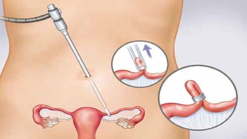 thắt ống dẫn trứng