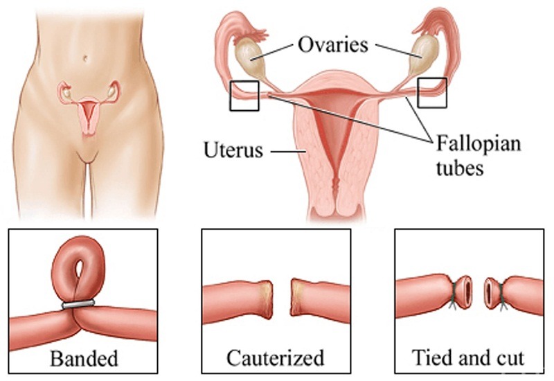 thắt ống dẫn trứng