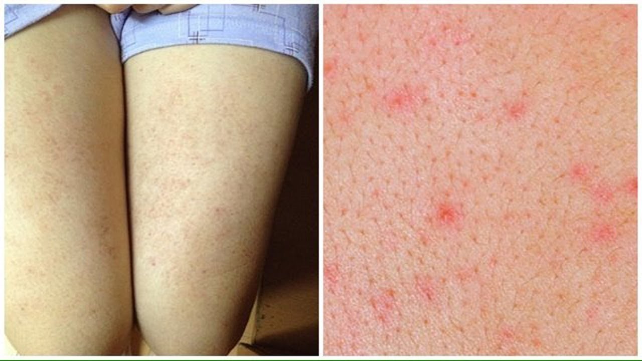 Cạo lông vùng kín bị ngứa: Nguyên nhân, Triệu chứng, Cách khắc phục và Biện pháp phòng ngừa 11 viêm nang lông,
