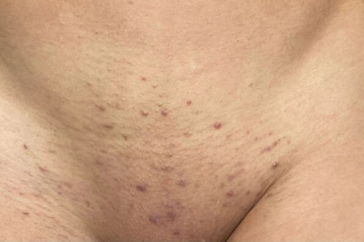 Cạo lông vùng kín nữ: Thông tin, Lợi ích, Rủi ro và Hướng dẫn chăm sóc 4 Viêm nang lông