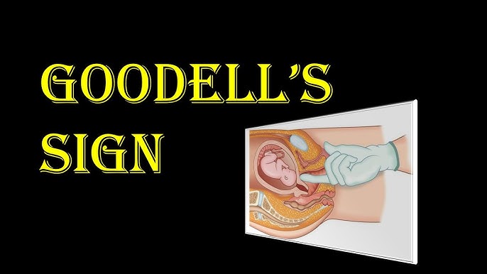 Dấu hiệu Goodell (Goodell's Sign)