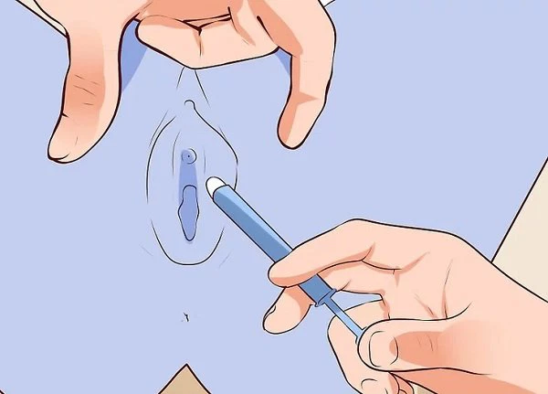 Gel Diệt Tinh Trùng: Thông Tin, Cơ Chế Hoạt Động, Hiệu Quả và Hướng Dẫn Sử Dụng An Toàn 4 Đưa gel vào âm đạo