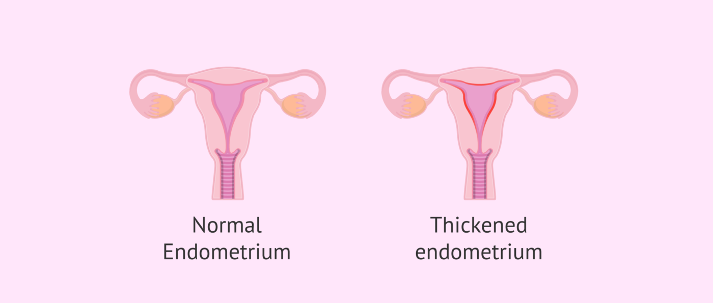 Endometrial Alteration