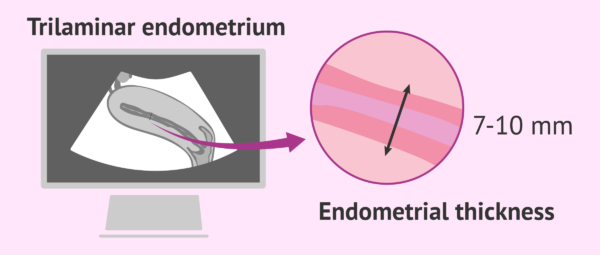 Endometrial Thickness Standards
