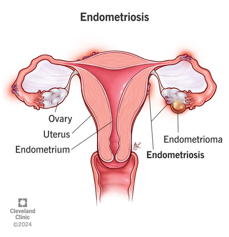 Vỡ nang trứng có sao không? Nguyên nhân, Triệu chứng, Mức độ nguy hiểm và Cách xử lý 2 Endometriomas