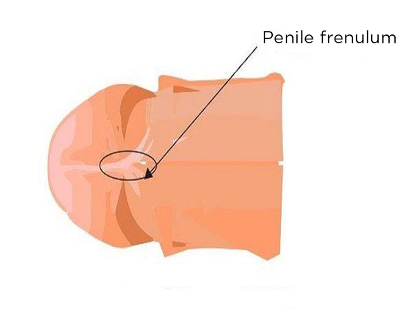 Frenulum Tear