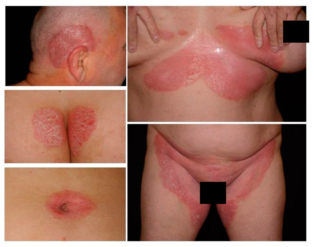 Genital Psoriasis