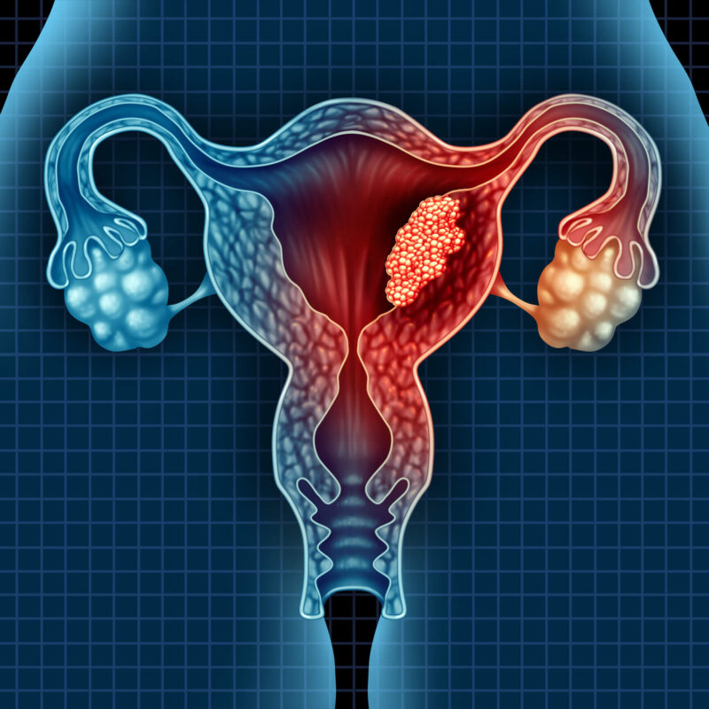 Gynecologic Cancers