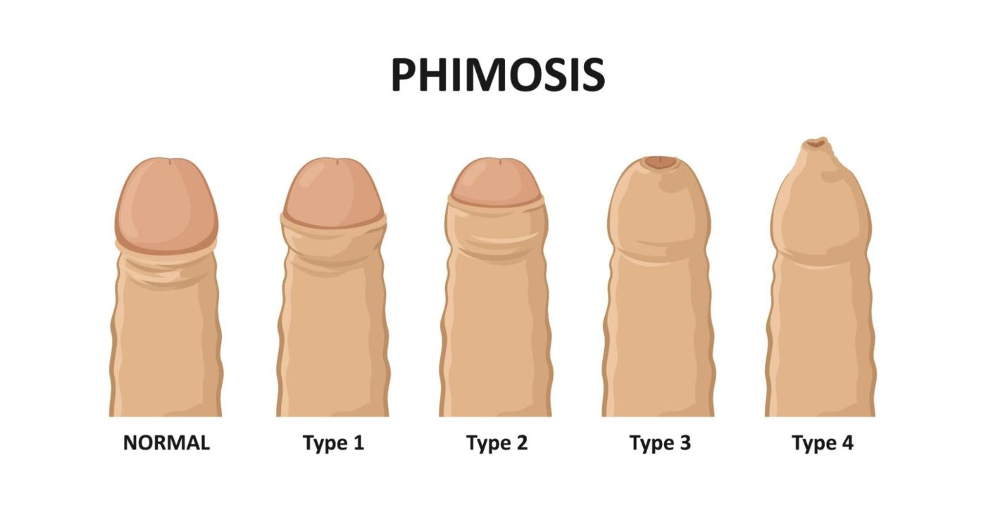 Phimosis