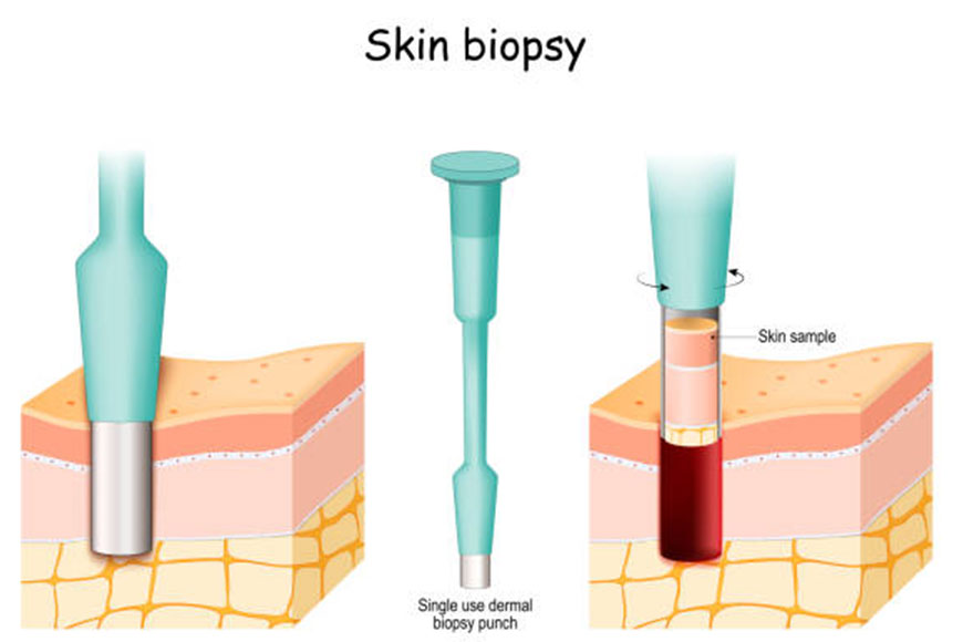 Skin biopsy