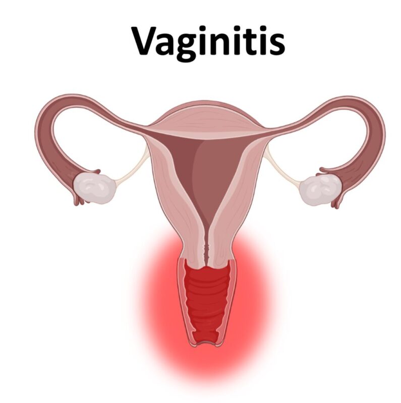 Vaginitis