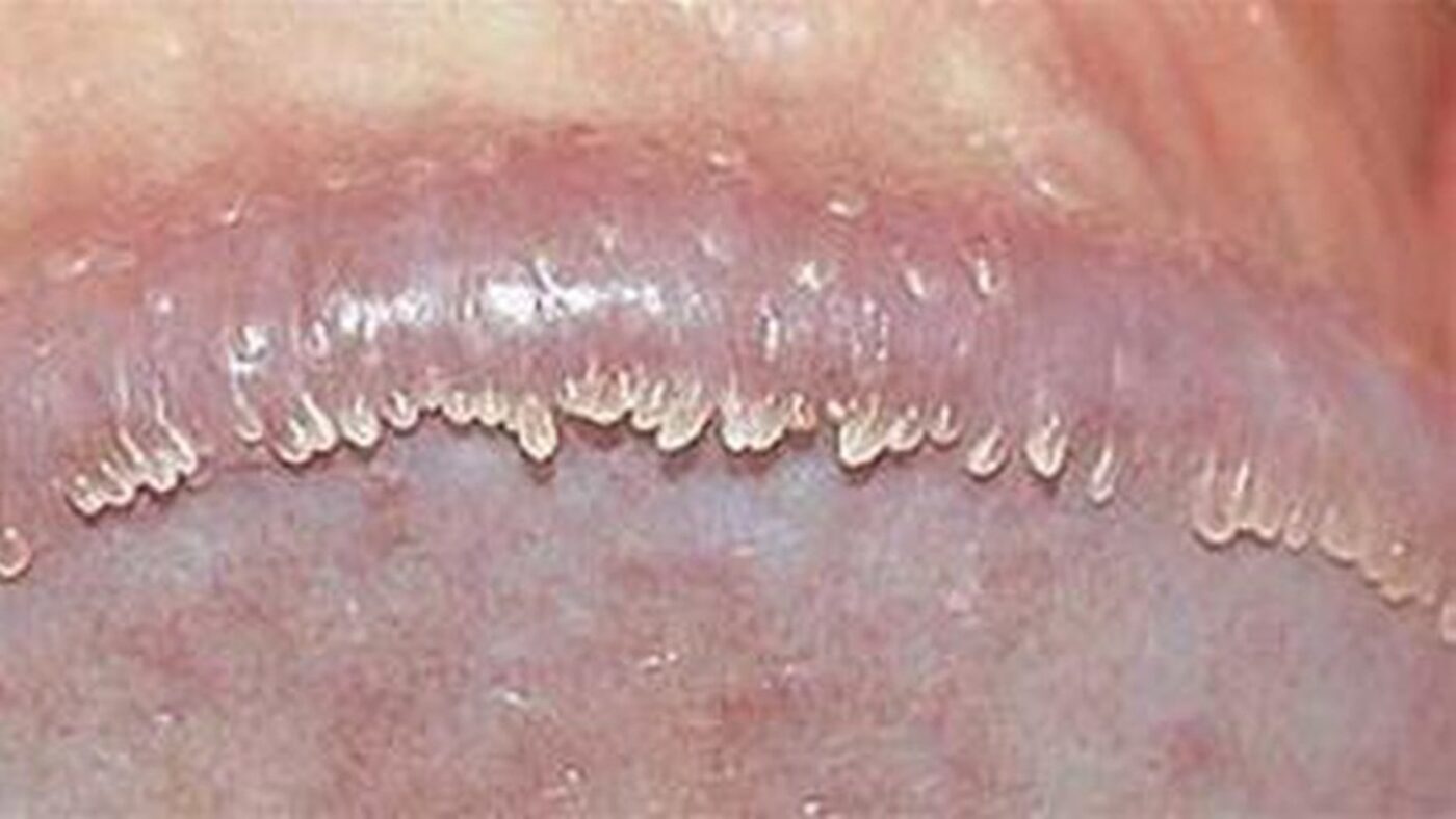 Gai Dương Vật: Nguyên Nhân, Triệu Chứng, Phân Loại và Các Phương Pháp Điều Trị 3 Chuỗi hạt ngọc dương vật