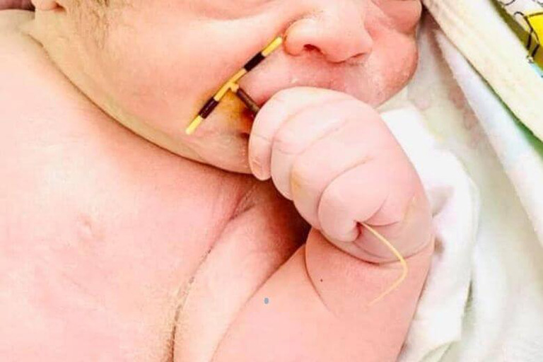 Có nên giữ thai khi đang đặt vòng