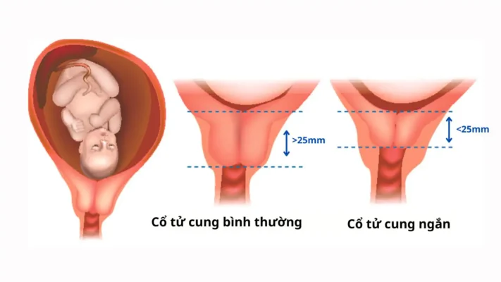 Chiều dài cổ tử cung bao nhiêu là bình thường: Thông tin, Chỉ số chuẩn và Cách xử lý 2 Cổ tử cung ngắn
